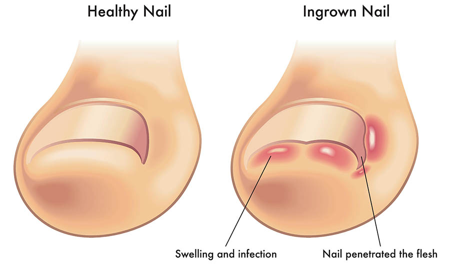 Ingrown Nail Surgery